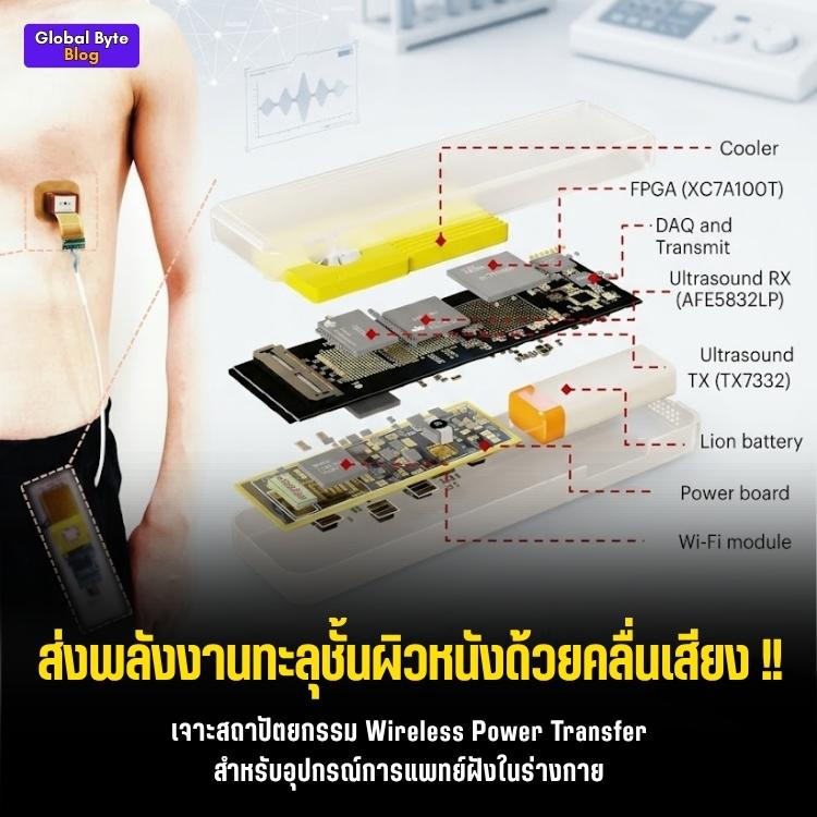 บอกลาการผ่าตัดอก! พาส่องนวัตกรรม "พลาสเตอร์อัลตราซาวด์" คุมจังหวะเต้นหัวใจจากนอกร่างกาย